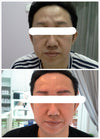 Skin Rejuvenation