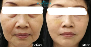 Aqua Filling - Anti Aging Face Lifting