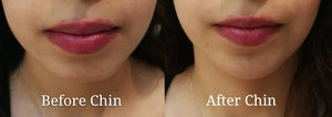 Aqua Filling- Chin / Breast / Buttock Augmentation