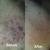 Medi-Facials - Acne Scar treatment