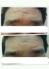 Forehead wrinkle
