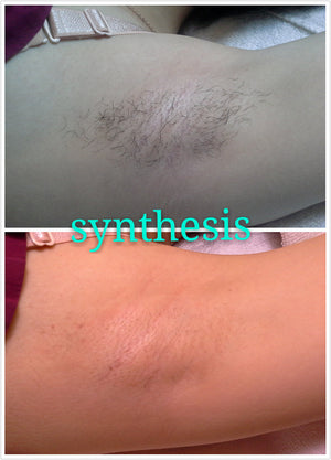 Laser Hair removal