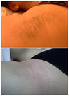 Laser Hair removal